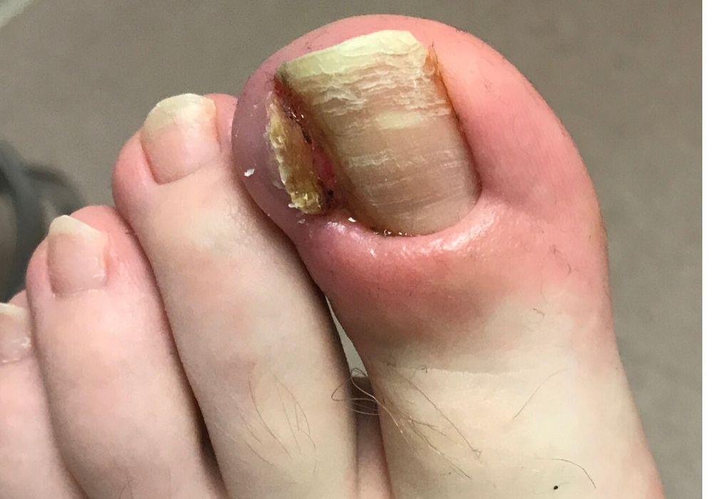 Ingrown Toenail