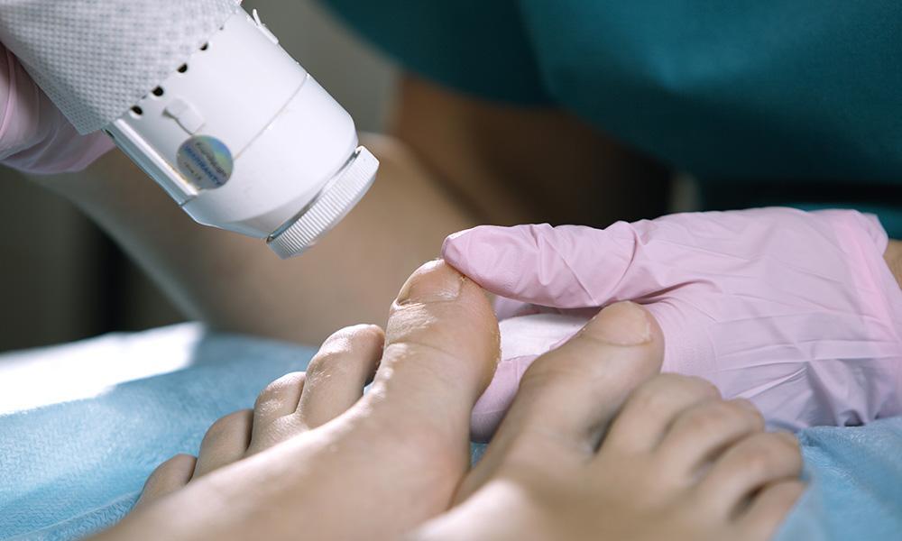 Laser Toenail Fungus Treatment