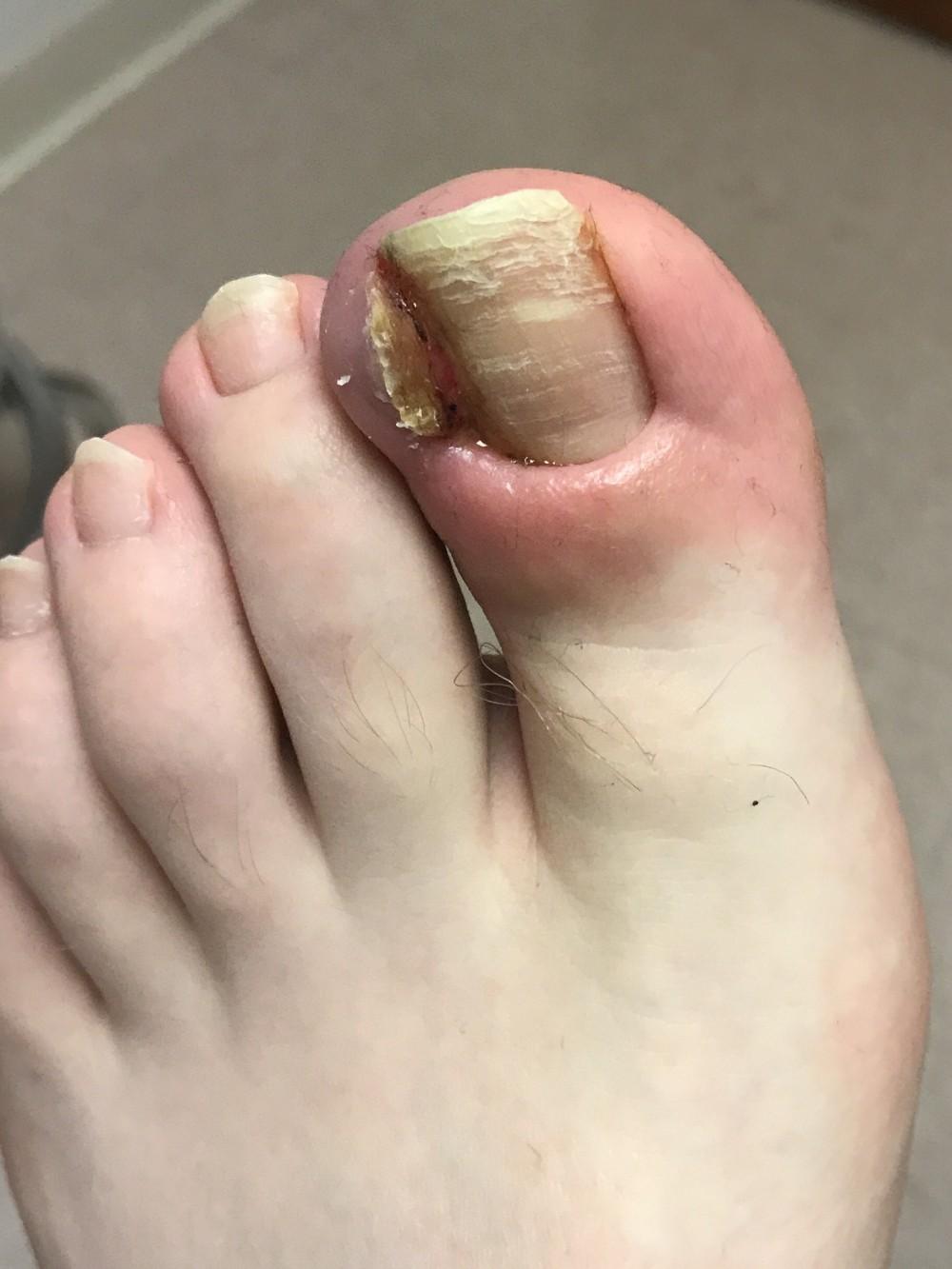 Ingrown toenail that needs matrixectomy