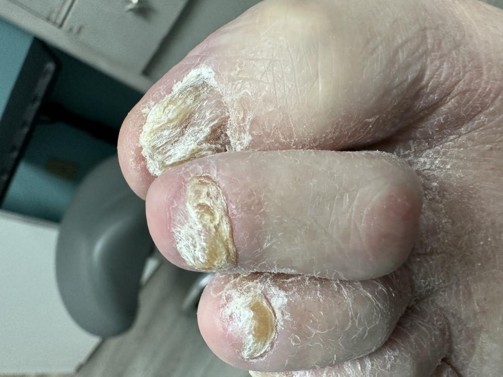 Description of a fungal toenail picture:  The image showcases a toenail affected by fungal infection. The nail appears discol