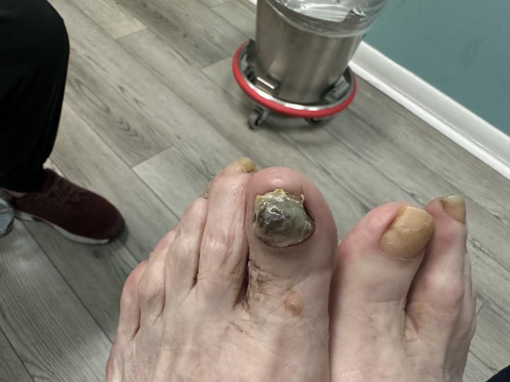 he photo showcases a fungal nail infection on a person's toenail. The affected nail appears discolored, with a yellowish-brow