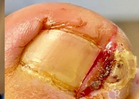 The image portrays a close-up view of an ingrown toenail on a person's big toe. The affected toe exhibits redness, swelling, 