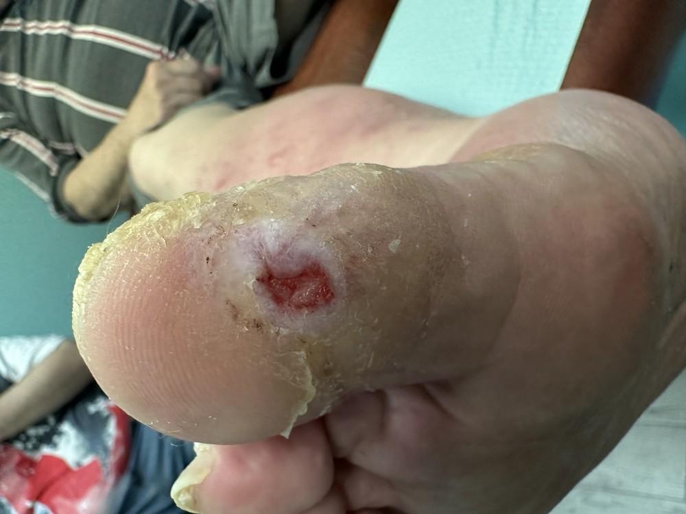 Diabetic Foot Ulcer, Red base, macerated tissue surrounding the centralized wound. Oval in shape.
